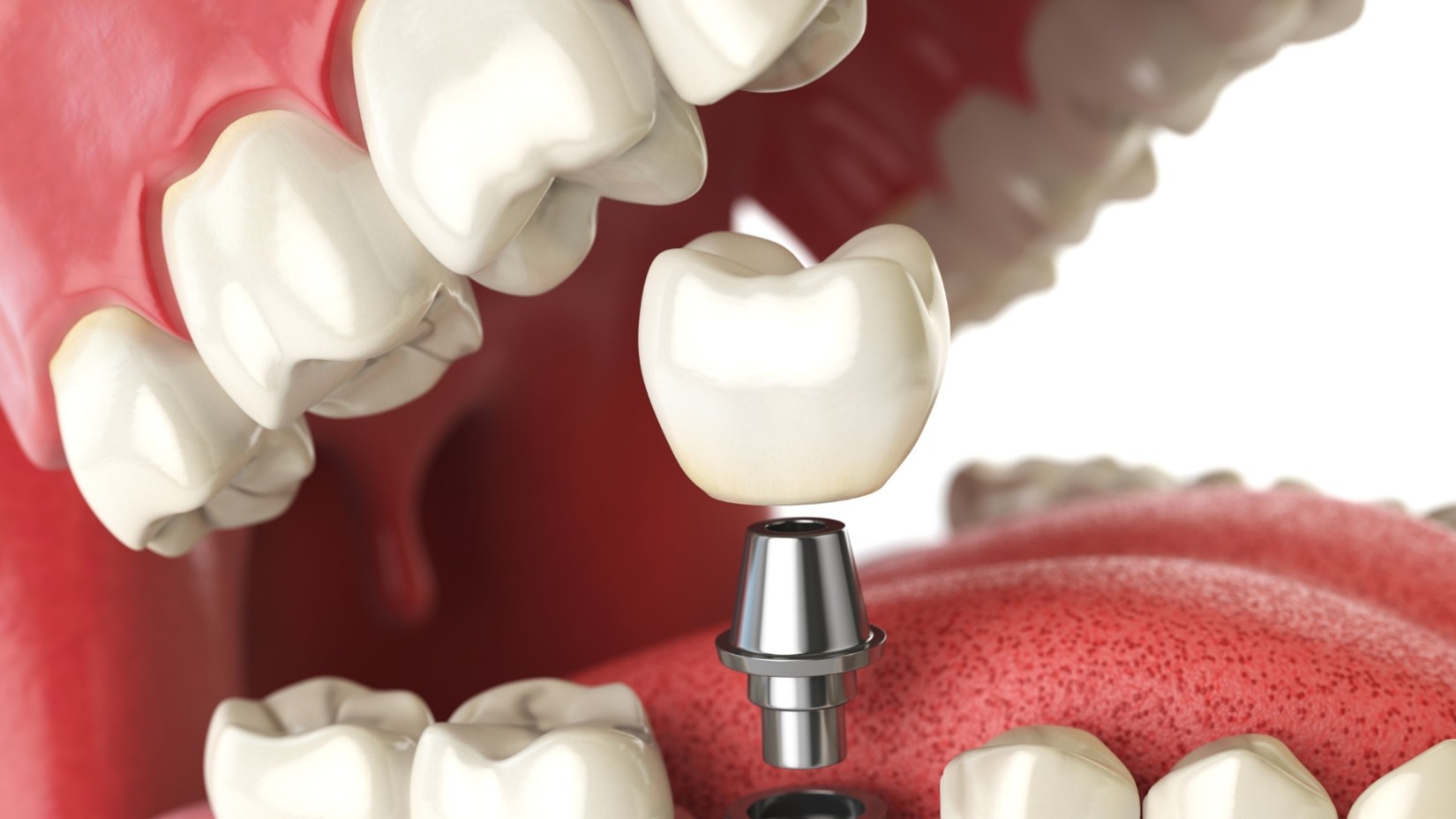 denture implants in Riverside